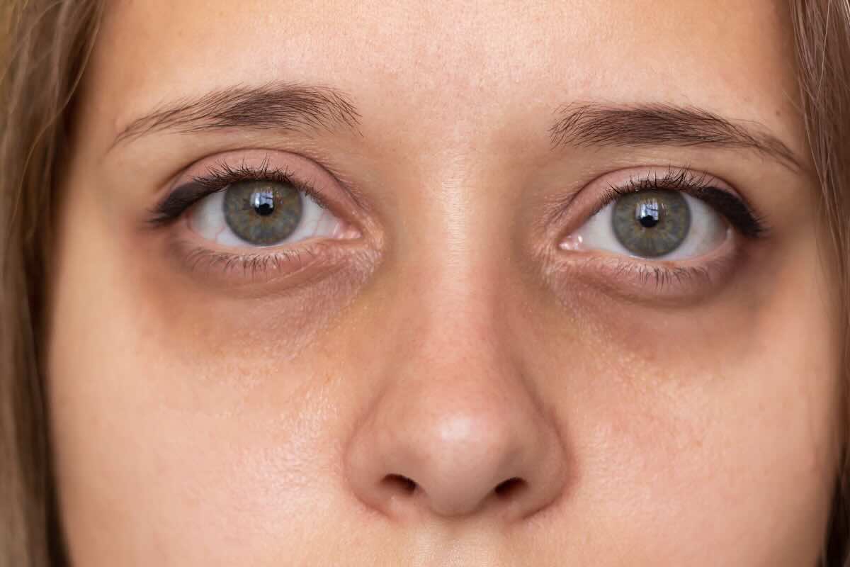 Contro le occhiaie le ho provate tutte ma solo con questi 4 metodi naturali ho messo fine al problema
