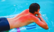 Uomo su materassino con scottatura evidente sulla schiena