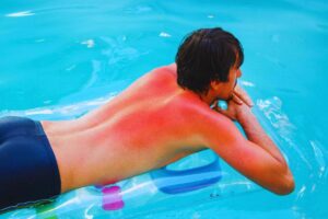Uomo su materassino con scottatura evidente sulla schiena