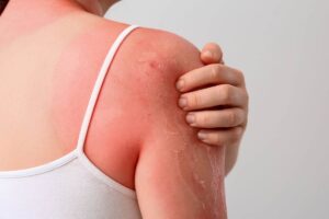 Donna con un grosso eritema sulla spalla