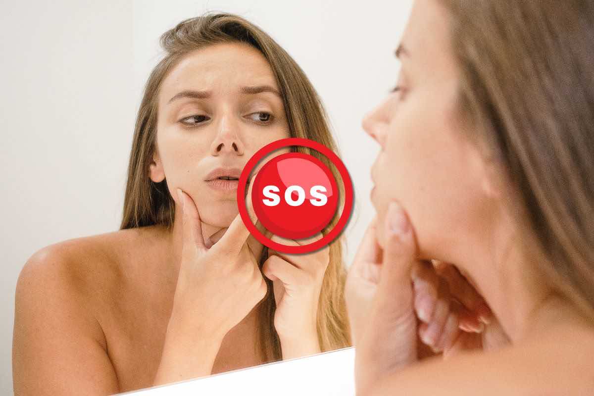 SOS brufoli sul viso? Tutti i rimedi naturali ed economici che trovi nella tua cucina
