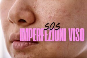 Pelle del viso e scritta 'SOS Imperfezioni viso'