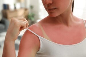 donna con scottatura e segno abbronzatura