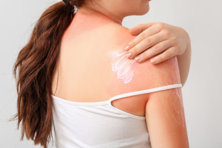 donna che mette crema su spalla
